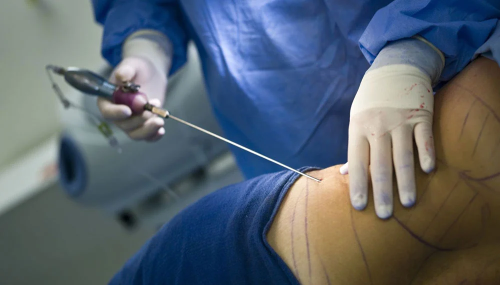 Liposuction or Tummy Tuck? What's Right For You?