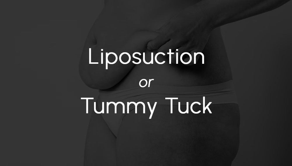 Liposuction or Tummy Tuck? What's Right For You?